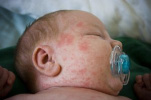алергии при новородени