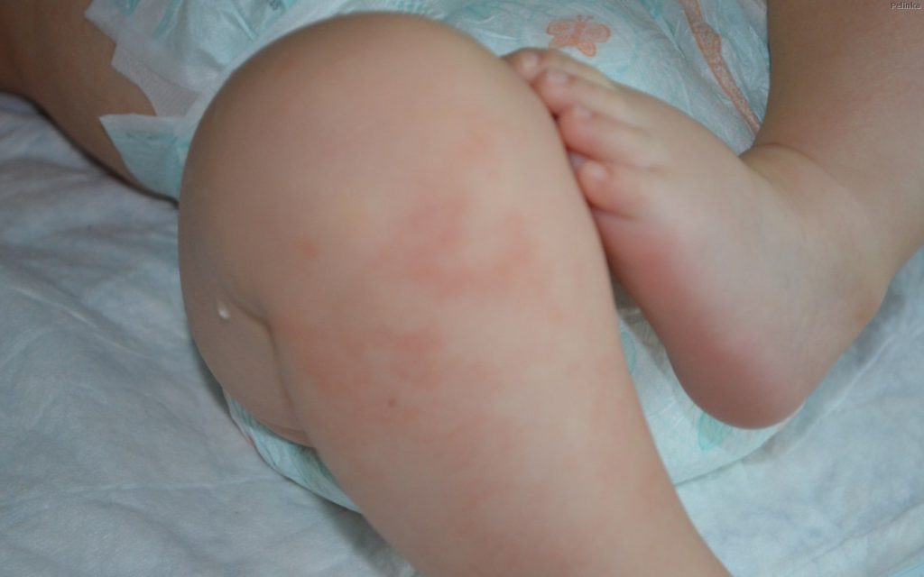 alergia en un niño