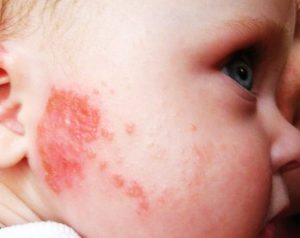 алергија код детета