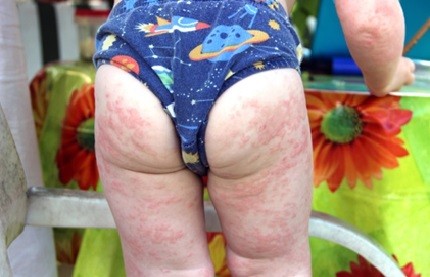 Проявата на алергии при деца